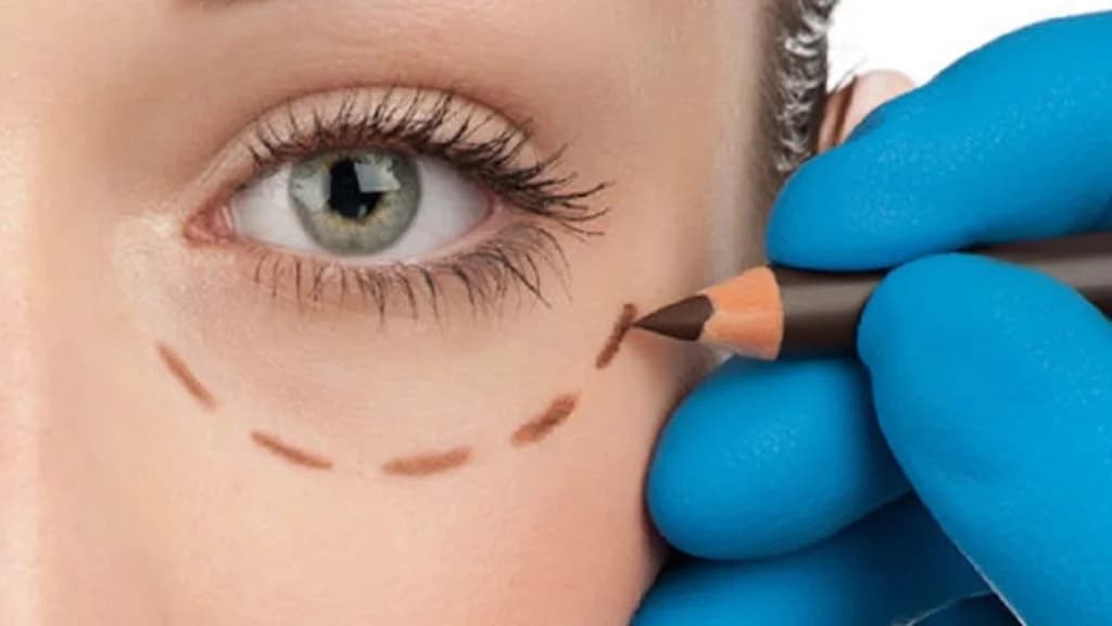 Oculoplasty